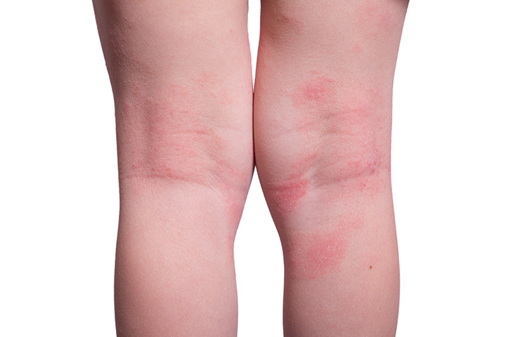 what-causes-rash-on-toddlers-body-live2long