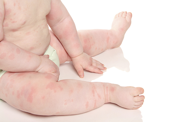 What Causes Rash On Toddlers Body Live2long Com